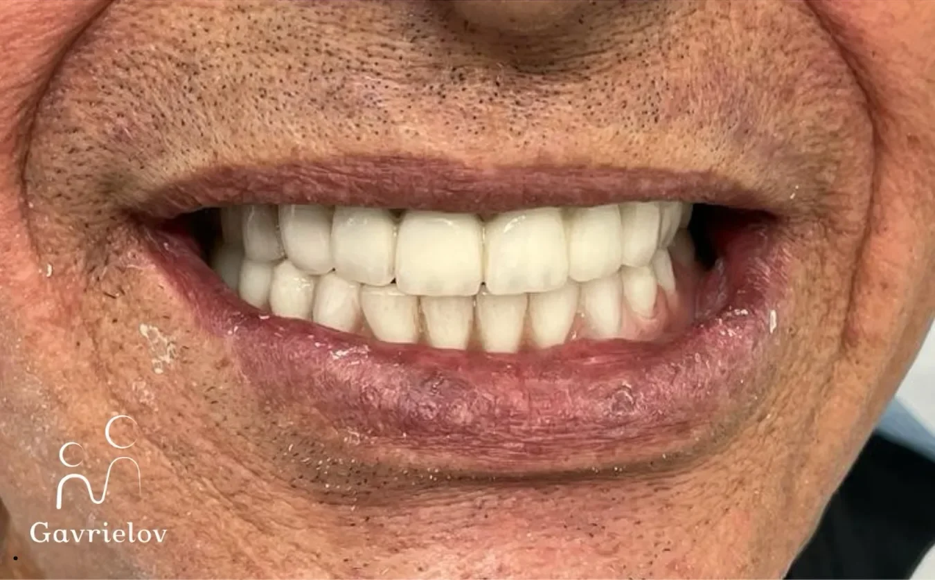 אחרי שיקום על שתלים